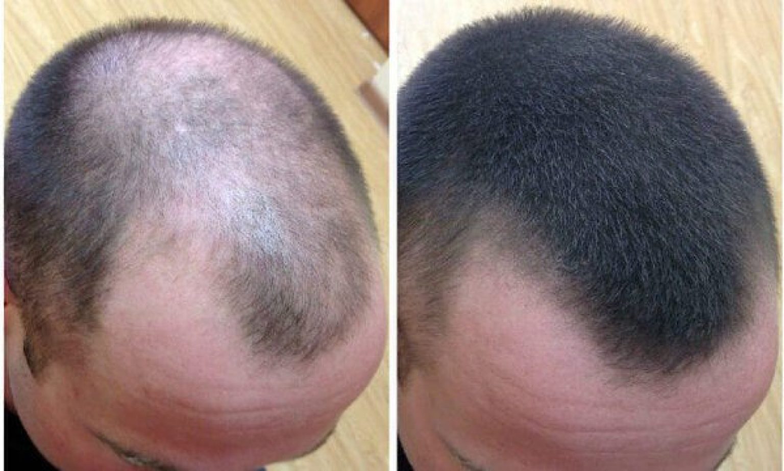 Как ускорить рост волос мужчине на голове. Миноксидил 5 для волос. Миноксидил для волос для мужчин для головы.